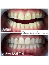 ホワイトニングサロン 京都烏丸店/ホワイトニング施術例