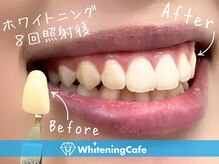 ホワイトニングカフェ 金沢店(WhiteningCafe)/◎歯のホワイトニング施術写真◎