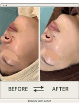 カラット(CARAT)/ララピール×ゲルマスク