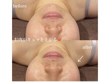 リュイール(LUIRE)/【フェイシャル】HI RF