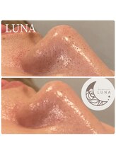ルーナ(LUNA)/☆ハイドロスキン1回施術結果☆
