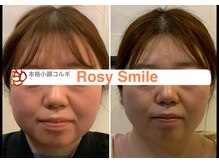 ロージースマイル(Rosy smile)/【韓国】　本格小顔コルギ　