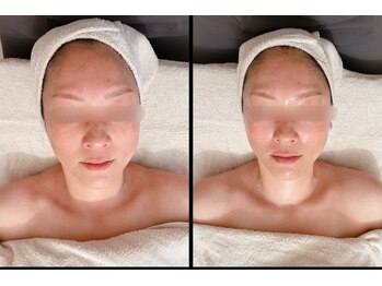 サロン シエラ/施術1回　40代