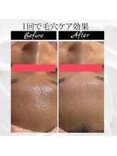 ポムポムボナー/ハイドロフェイシャル毛穴洗浄♪