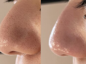 ラディエンス 多治見店/ヒト幹細胞毛穴ケア