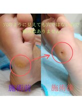 ドクターネイル爪革命 長野店/【たこ・うおのめ】リラク/足裏