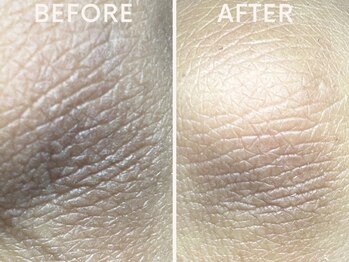 コハク(kohaku)/黒ずみ・角質にハーブ