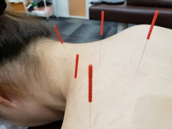 アラキ(ARAKI)/首痛い症状に鍼灸施術
