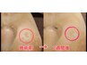 【しみケア】しみケアデトックスし放題40分☆数が多い方必見！　¥8,800