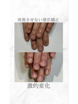 ティアラネイル 宇都宮/深爪矯正