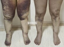 術後インディバ専門サロン 新宿/太もも吸引/術後インディバケア