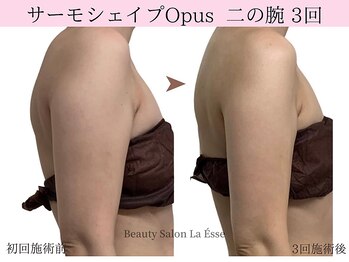 ラエッセ(La Esse)/ほっそり二の腕もつくれる〇