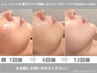 剥離なし漢方ハーブ6回コース☆ハーブピーリング＋シェービング