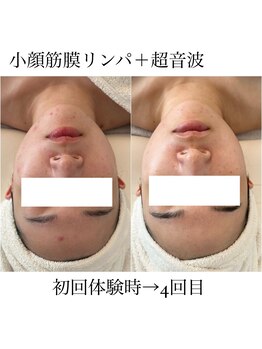 イム(I'm.)/小顔筋膜リンパ+超音波