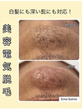 エンネソルミオ(Enne Solmio)/美容電気脱毛♪