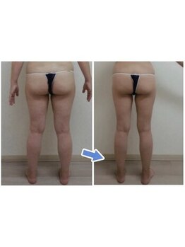 ビューティースパ/むくみやすい足/リンパで解消♪