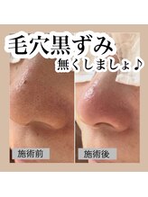 ニュートラル(neutral)/毛穴エクストラクションプロ大分