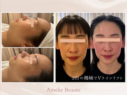 アメリーボーテ原宿【インモード/マイクロ波/テラボーラー/エンビロン】の写真