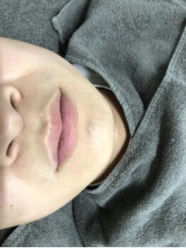 ルナ 植木店(Luna)/men's脱毛