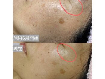 アンベリール/シワ改善も