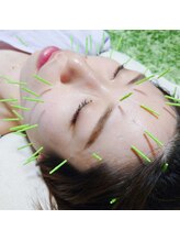 アスミルはり灸接骨院/こんなに細いんです！