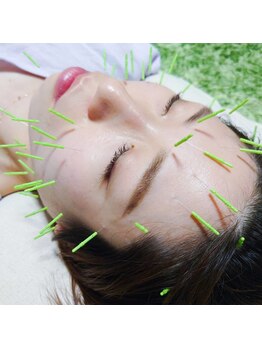 アスミルはり灸接骨院/こんなに細いんです!