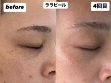ヘアファッション ユミ(HAIR FASHION YUMI)の雰囲気（韓国肌管理【ララピール】初回限定で¥16,500→¥8,580！）