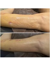 ミイン(美in)/術後拘縮改善