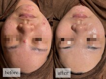 ヒナノ 矢場町店(HINANO)/乳酸菌ピーリング