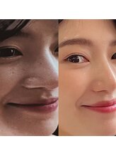 エミニナル(EMININAL)/【フェイシャル】変化