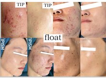 大人女性のお悩みに特化したサロンです。ピーリングが人気です