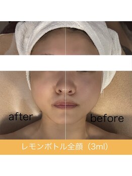 オプレア 栄店(OPREA)/レモンボトル