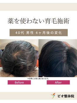 ビオ接骨院 小牧院/再生育毛促進術
