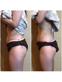 エステサロン クブ(Kubu)/インキュア