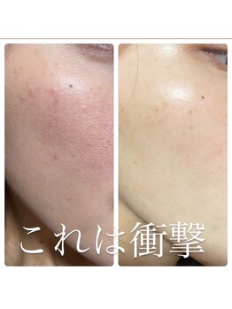 アイラッシュ ミル 御領店(eye lash Miru)/剥けないハーブピーリング!!