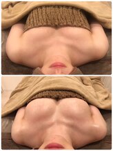 リール 新宿店(RIRE)/20代後半　バストアップ症例