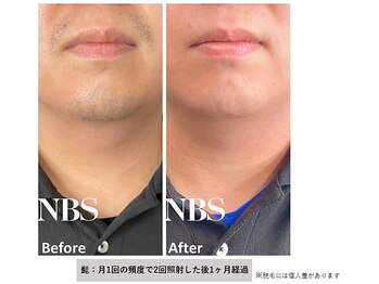 エクラ(E'clat)/男性ひげ脱毛２