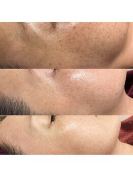 マリス(MARISS)/ハーブ5回【小顔/毛穴/シミ】