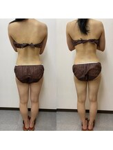 ビオルブ(VIOLVE)/痩身施術前後ビフォー・アフター