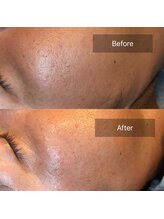 セメ(S’aimer)/男性の肌改善もハーブピーリング