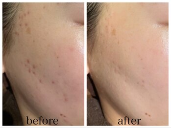 アリエス/ポレーションで跡の改善