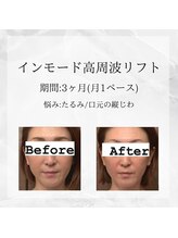 メディカルエステ 東銀座店/業界初インモード高周波リフト 