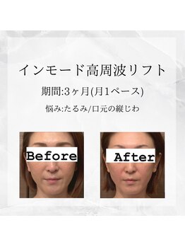 メディカルエステ 東銀座店/業界初インモード高周波リフト 