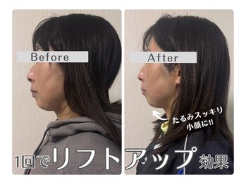 ルリアン(Lurian)/エステ1回でのBefore→After