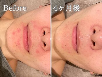 ポポラス(POPOLUS)/ニキビケア4ヶ月