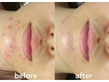 ホワイトアクア 鹿児島店(WHITE AQUA)/ハーブピーリング/ニキビケア