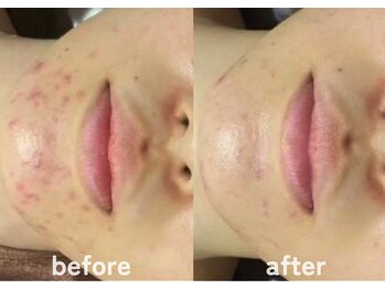 ホワイトアクア 鹿児島店(WHITE AQUA)/ハーブピーリング/ニキビケア