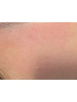 顔脱毛がしたい