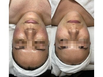 スパ ザ 睡(SPA The Sui)/気になってた赤み2ヶ月での変化