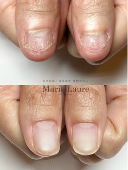 マリーロール 梅田店(Marie Laure)/自爪育成/深爪矯正/ネイルケア